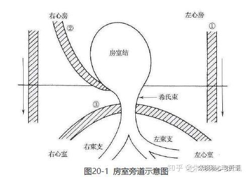 第二十讲:预激综合征(一) - 知乎