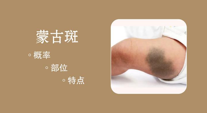 蒙古斑简述 知乎