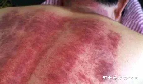 中医刮痧详解析：颜色、区域、形状代表的含义 - 知乎