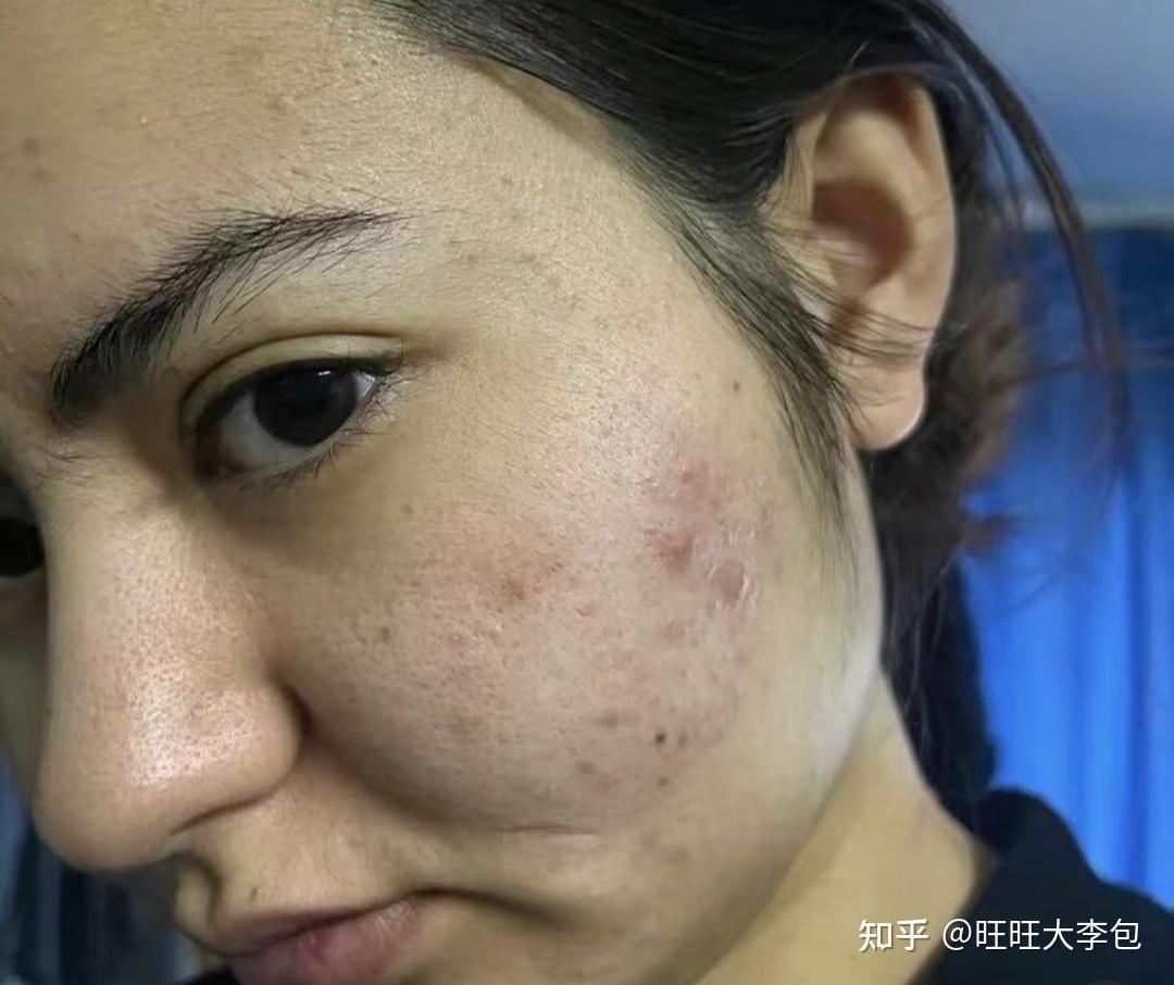 用针把痘痘弄破,会好吗? - 知乎