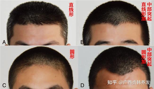 M型发际线早晚会秃?除了植发别无它法了吗? - 知乎