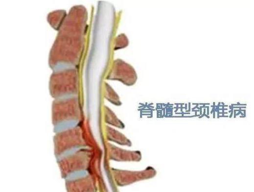 最严重的颈椎病有哪些症状 知乎 最严重的颈椎病有哪些症状 知乎
