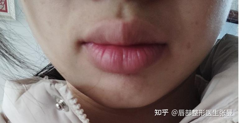 嘴唇太厚且上唇厚于下唇,没有形状怎么办? - 知乎