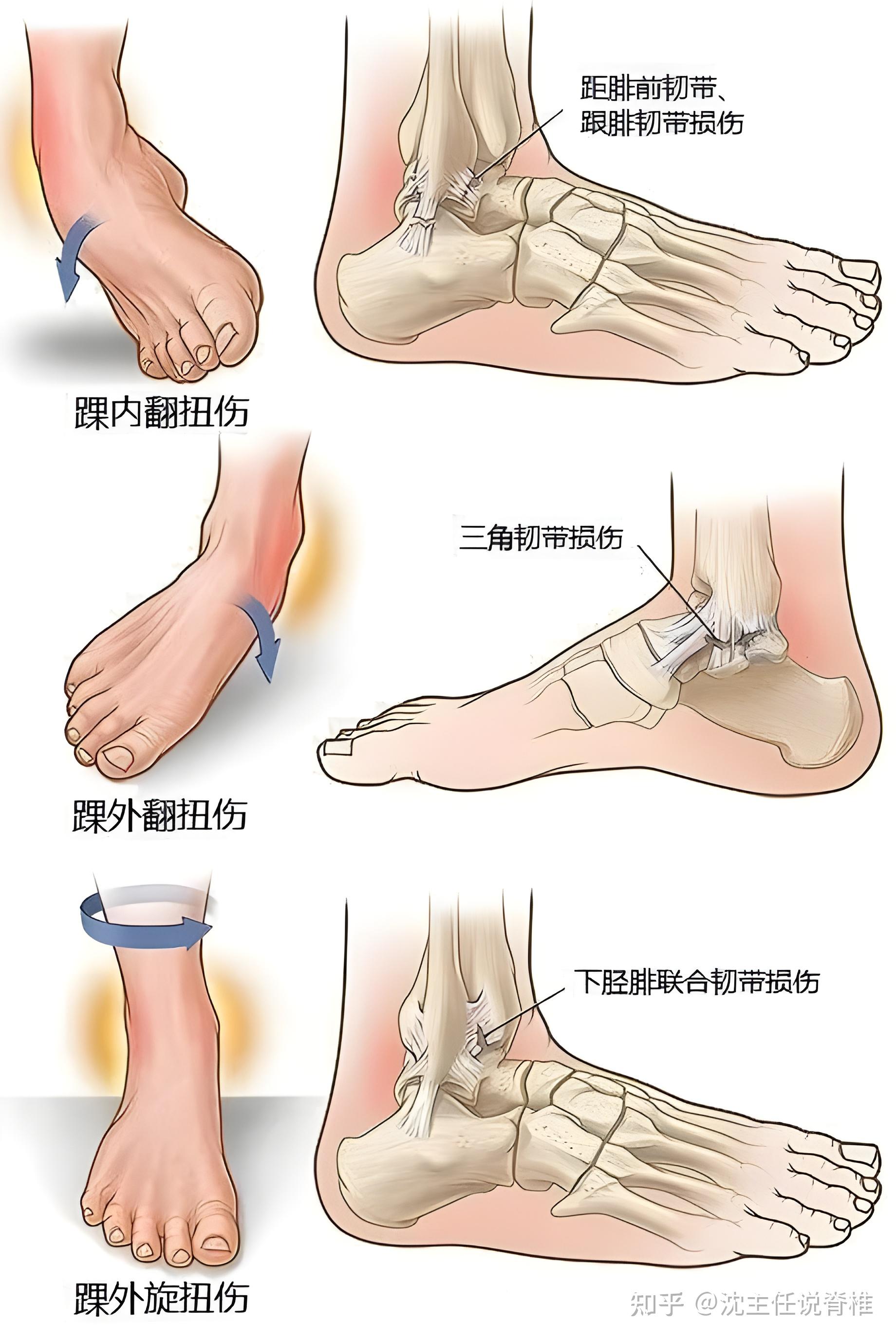 脚踝内翻扭伤的病理结构