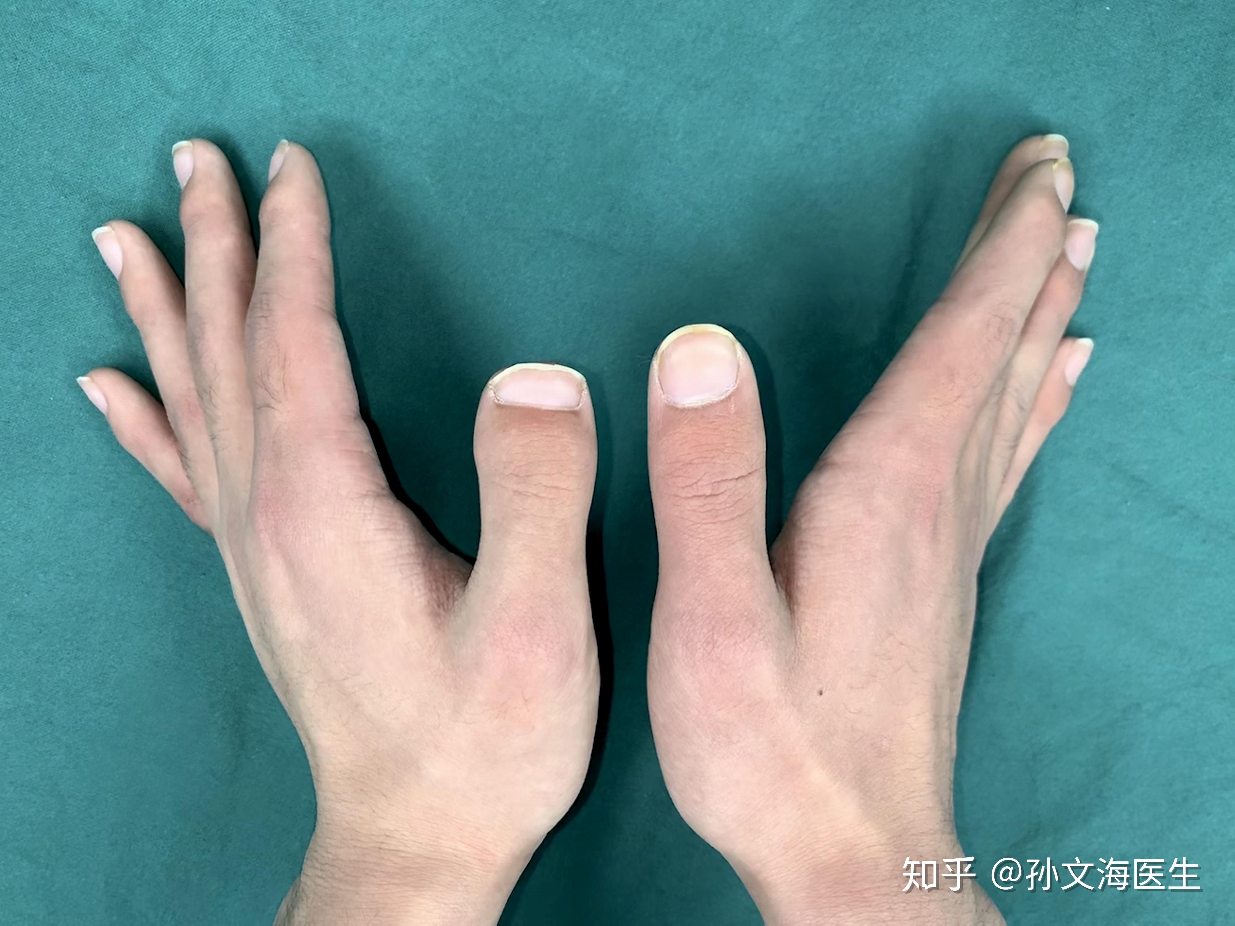 为什么我的大拇指又宽又短