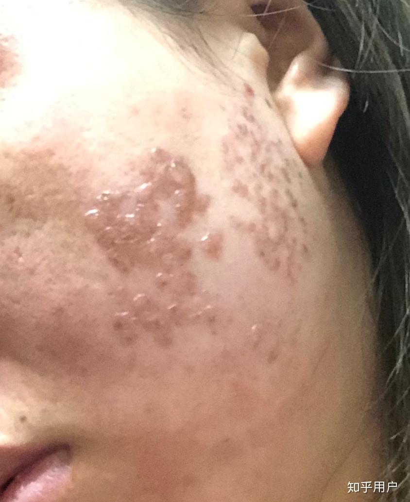 激光祛斑后出水泡会留疤吗