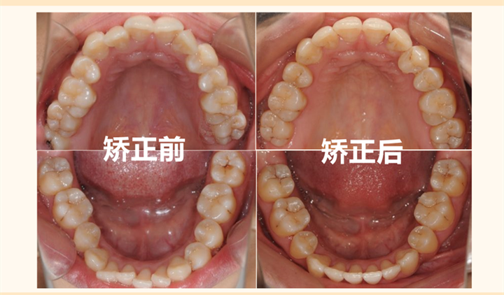 贵阳牙齿矫正丨正畸案例x片更能证明脸型的变化