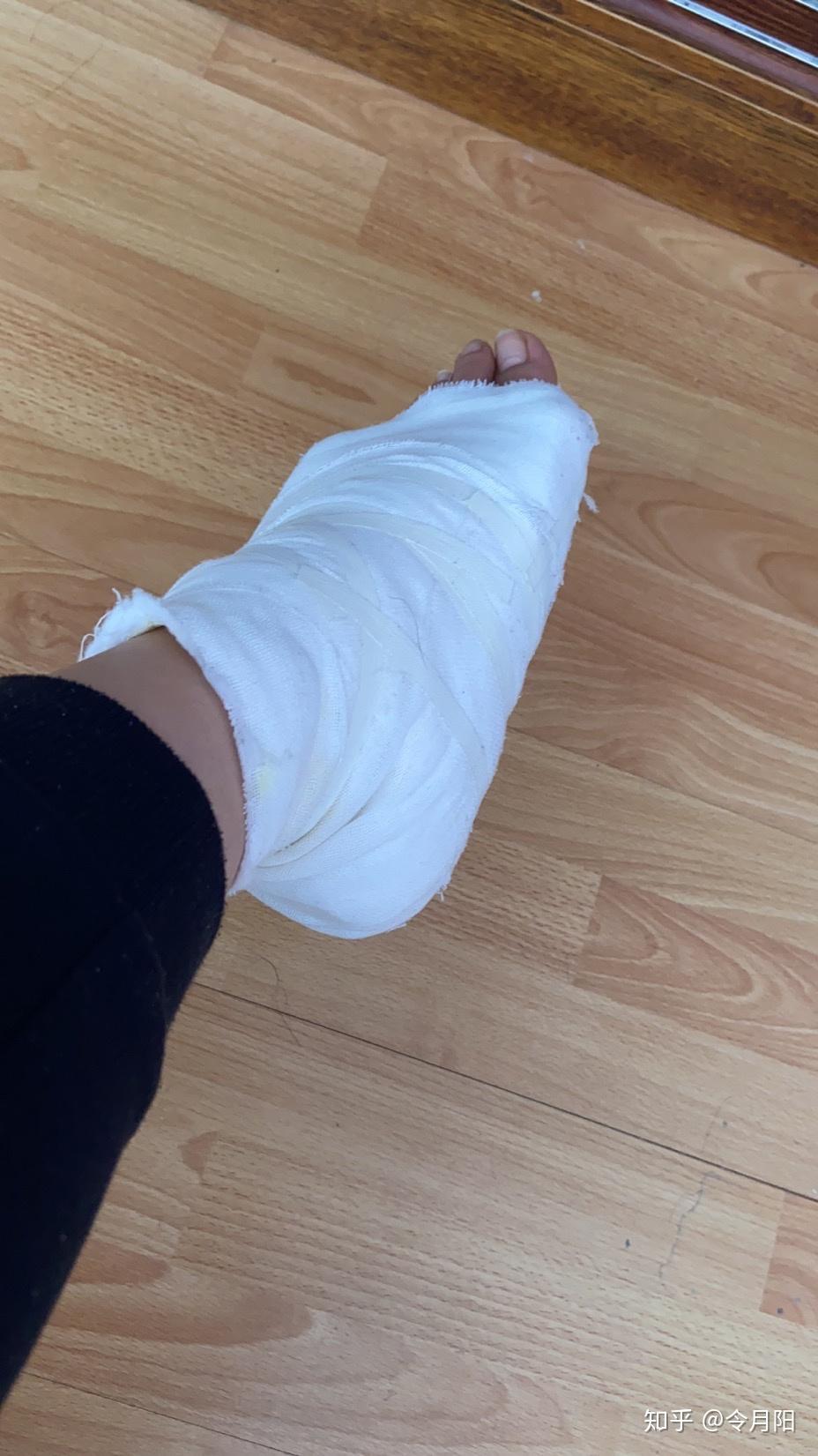 扭伤后脚背有肿块,请问怎么消肿? - 知乎