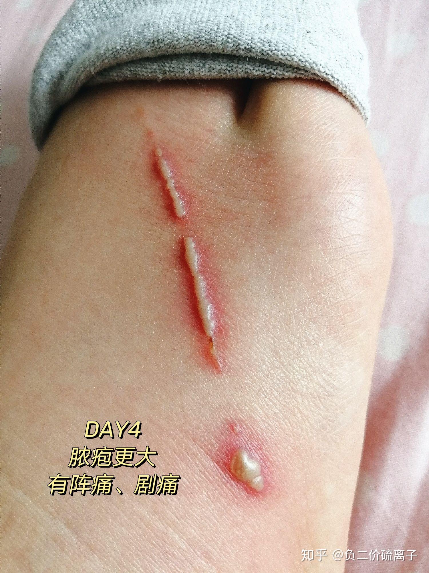 隐翅虫咬后的水泡能不能挤? - 知乎