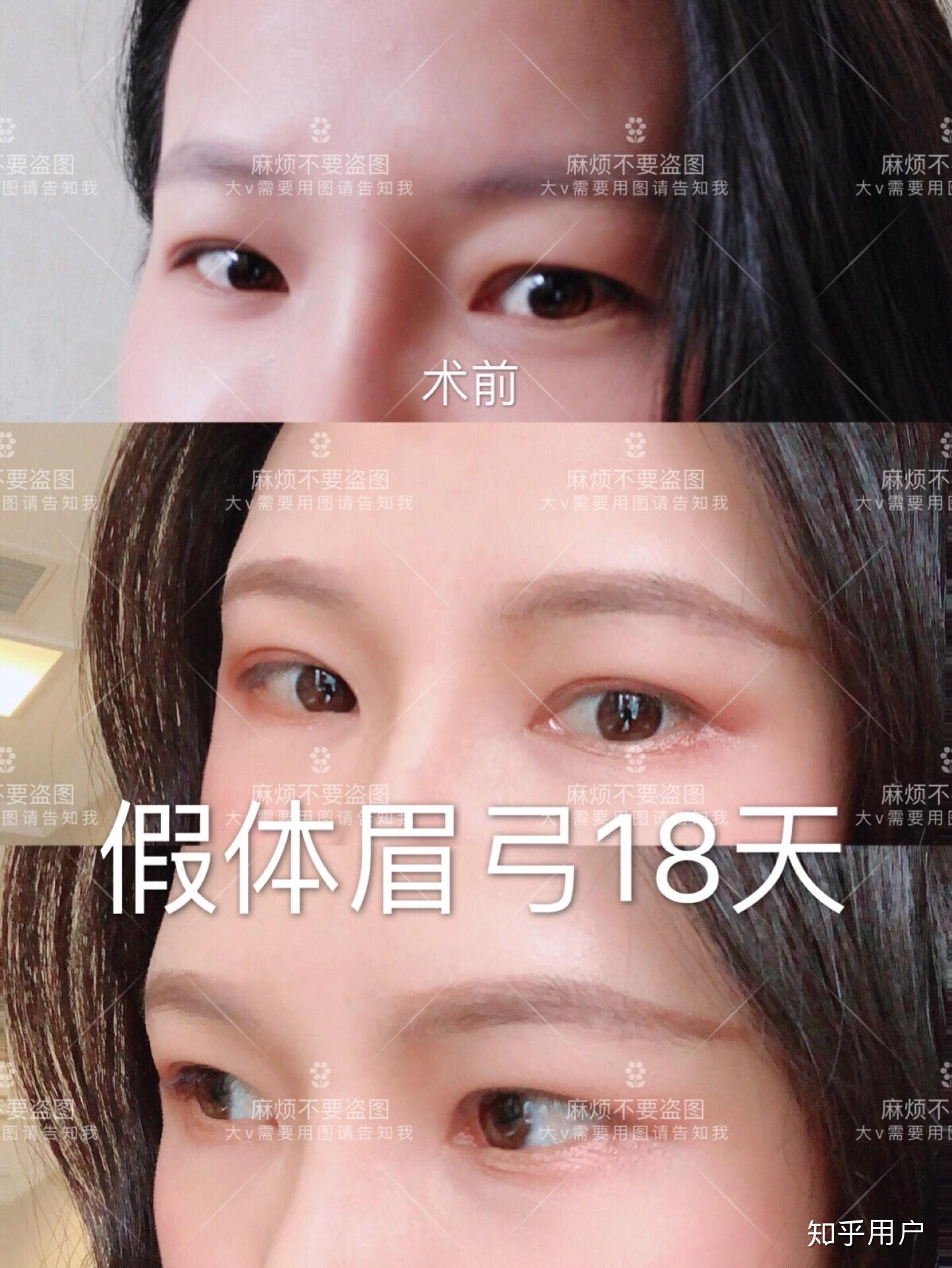 做膨体假体隆眉弓真的会下移吗