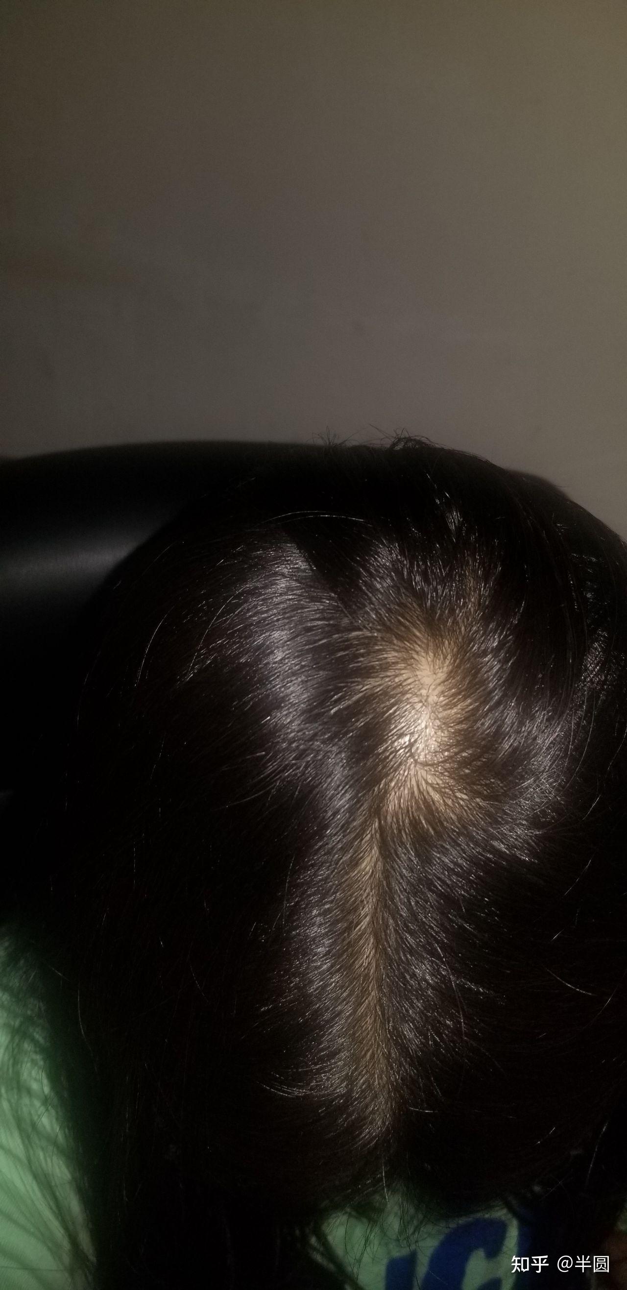 我这头顶漩涡处头发量正常吗? - 知乎