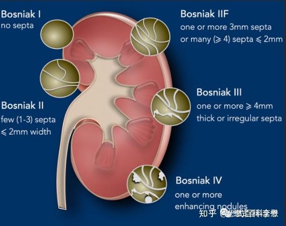 肾脏囊性病变的Bosniak分级 - 知乎