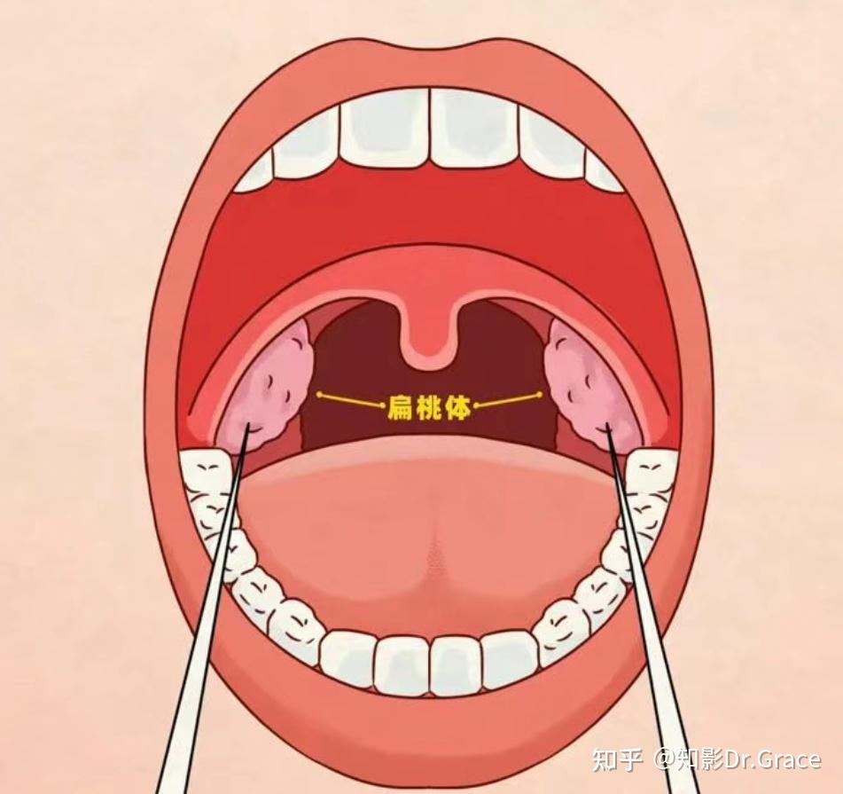 低龄儿童有必要做扁桃体切除术吗?