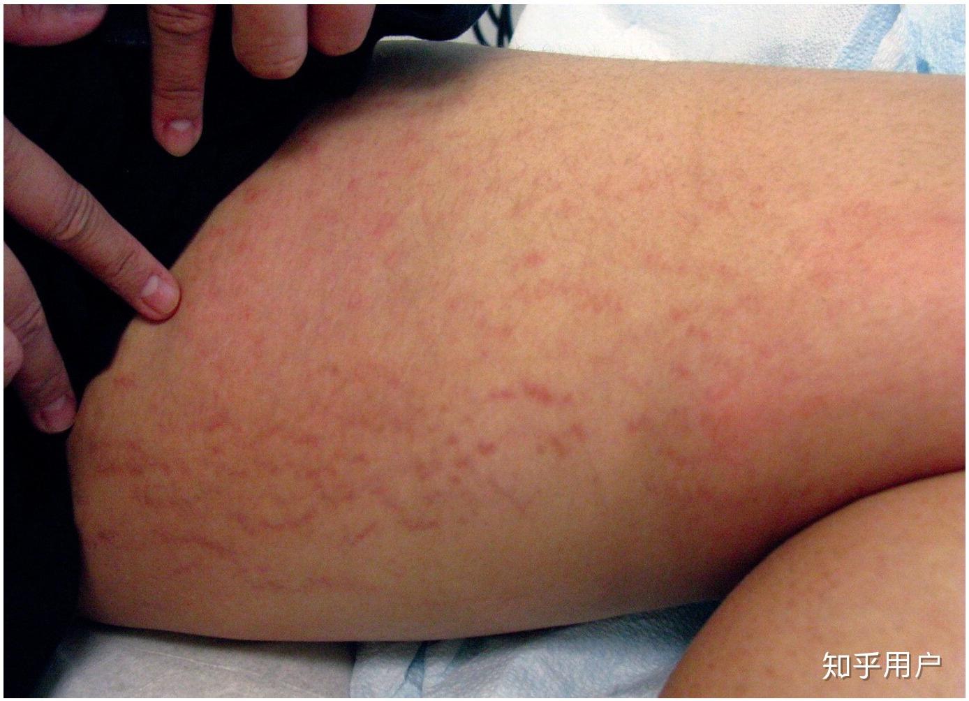 生完宝宝后,腹部的妊娠纹怎么消除? - 知乎