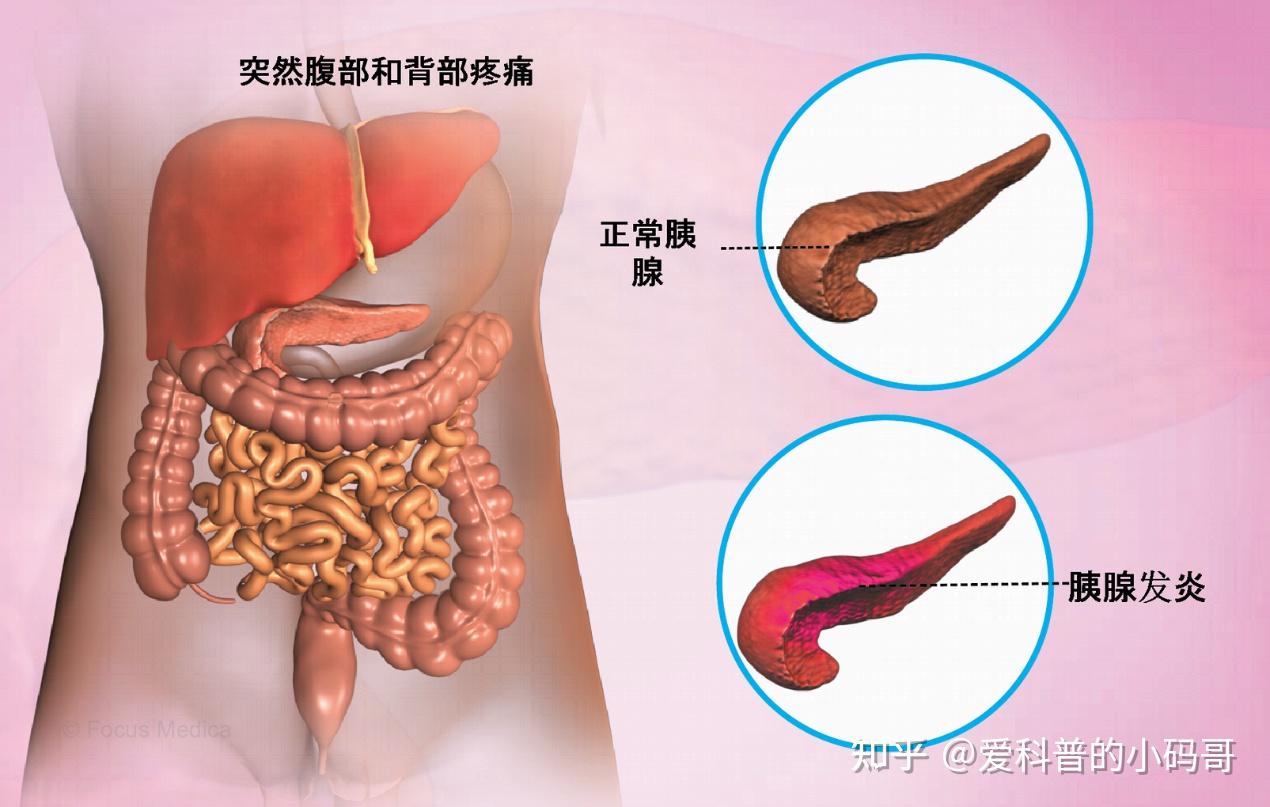 慢性胰腺炎 zhuanlan.zhihu.com