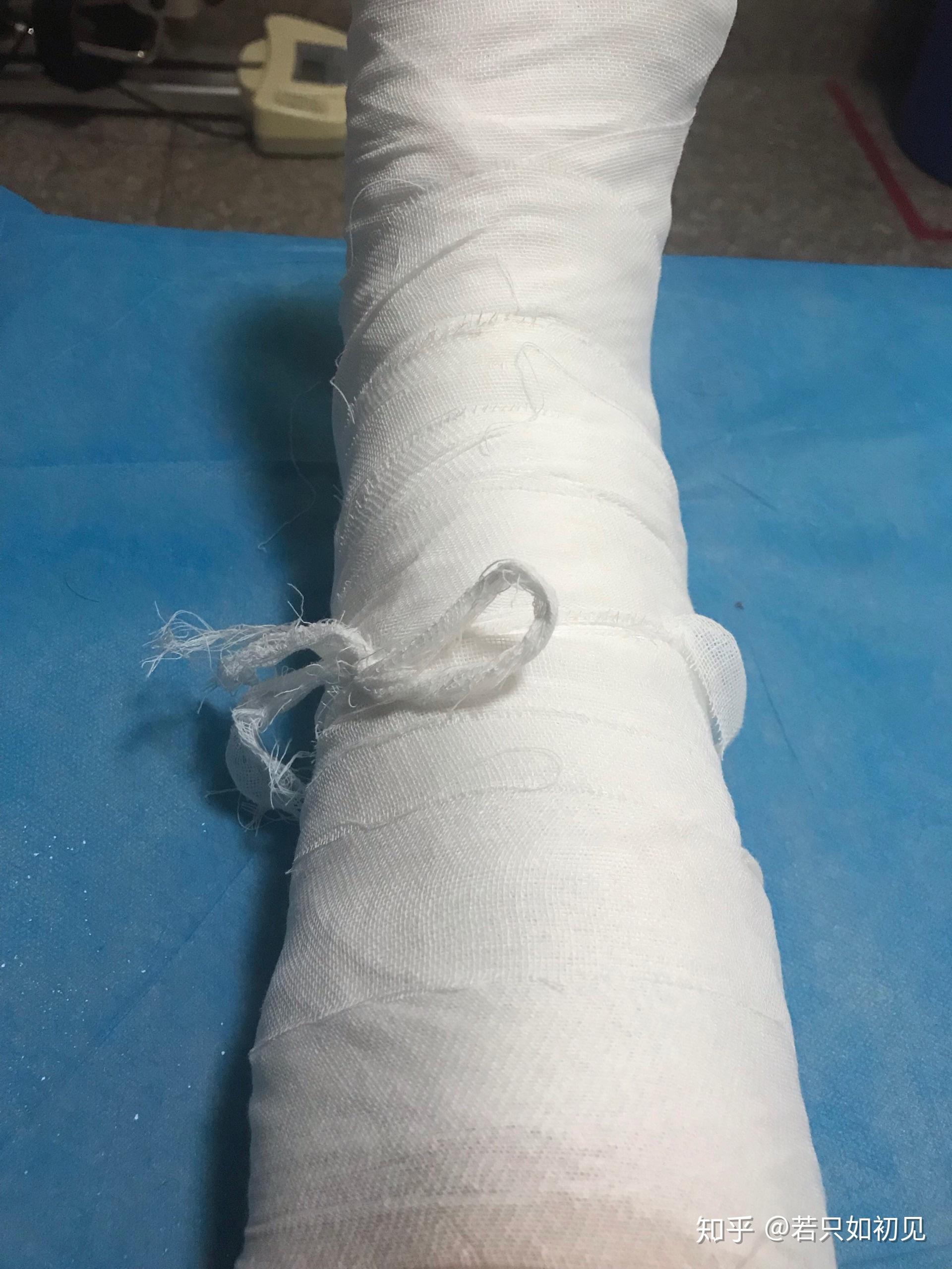 崴一脚骨折的可能性大么?