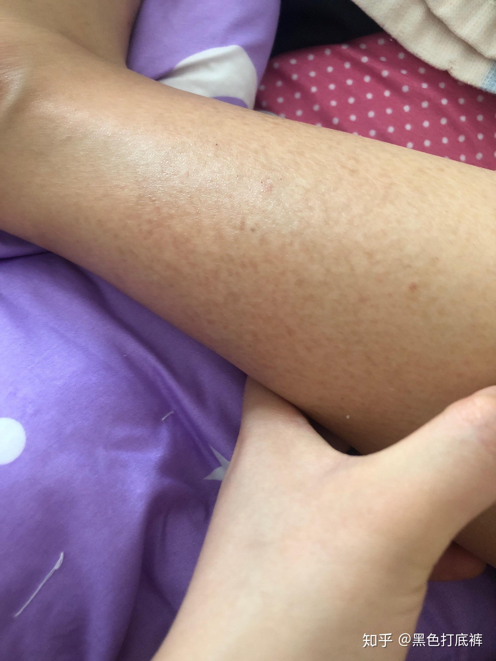 身上长有鱼鳞病,就是常说的蛇皮,怎么办?