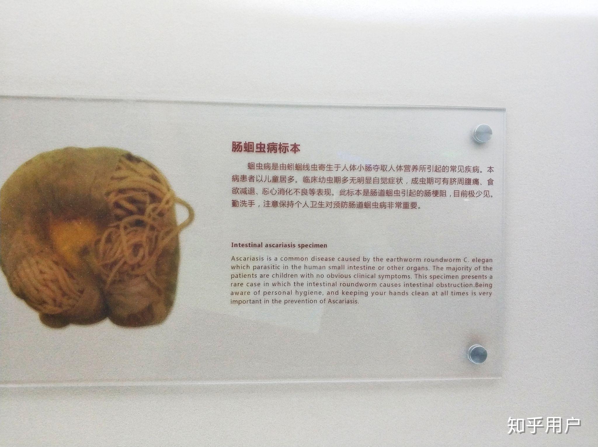 蛔虫对人体影响有多大