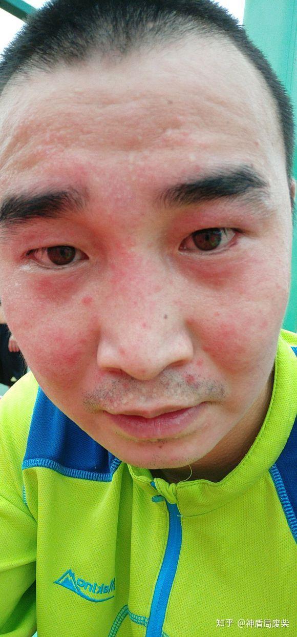 头面部银屑病到底怎么办反反复复22岁大学生