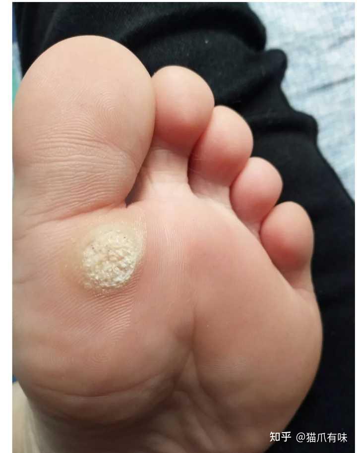 请求辨别这是鸡眼还是跖疣?