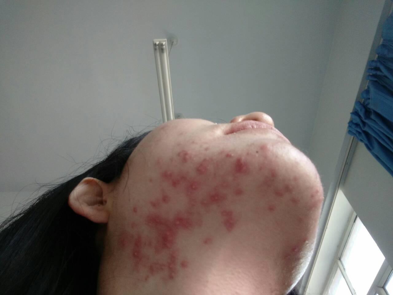 嘴周围一直发痘痘一开始红红的凸起然后就有脓头的那种谁能教教我好几