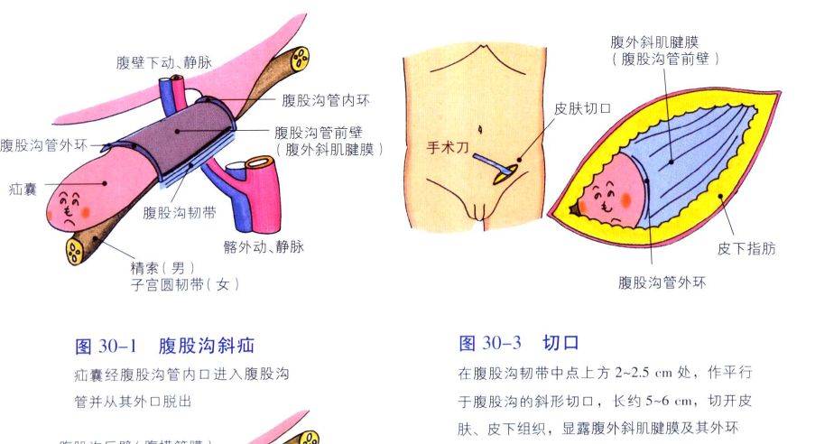 女性腹股沟疝气对生育影响大吗? - 知乎