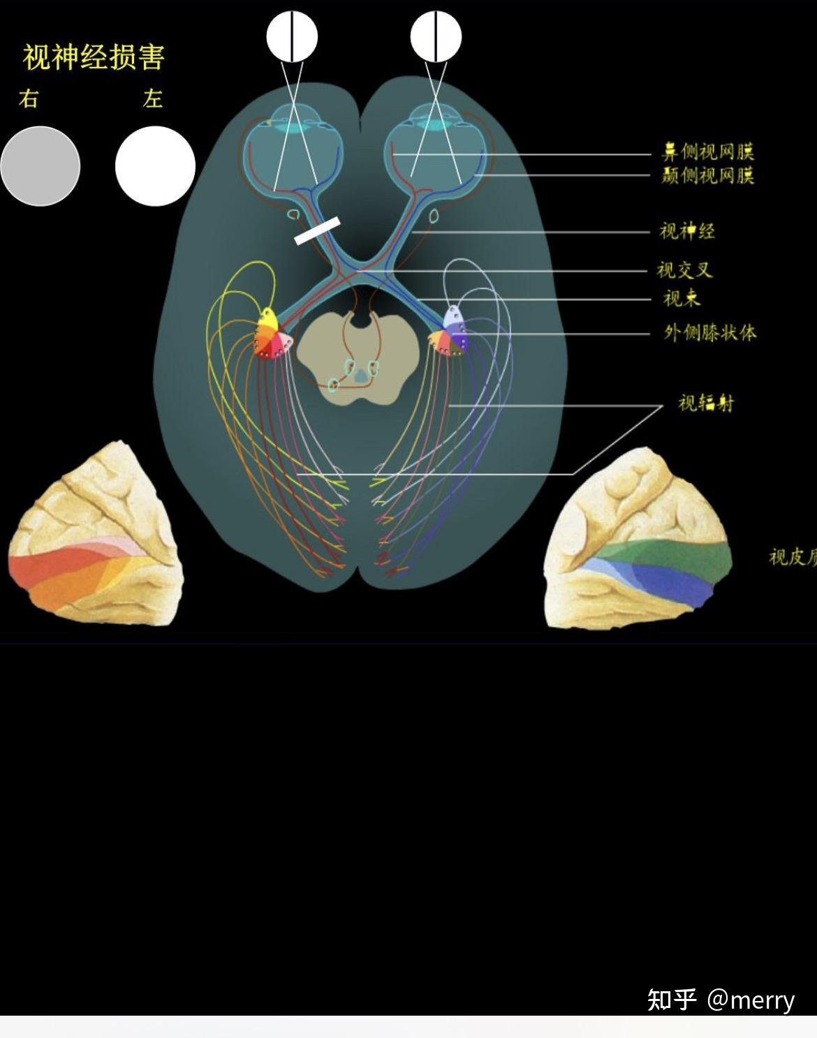 為什麼一側視神經損傷會引起同側視野偏盲? - 知乎