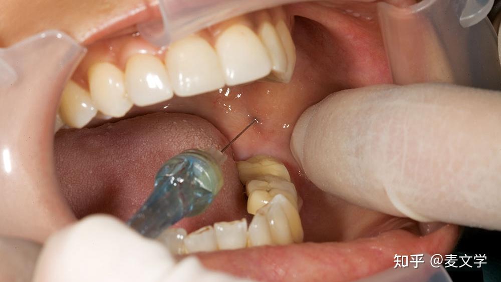 下颌神经阻滞麻醉怎样才能打准呀?