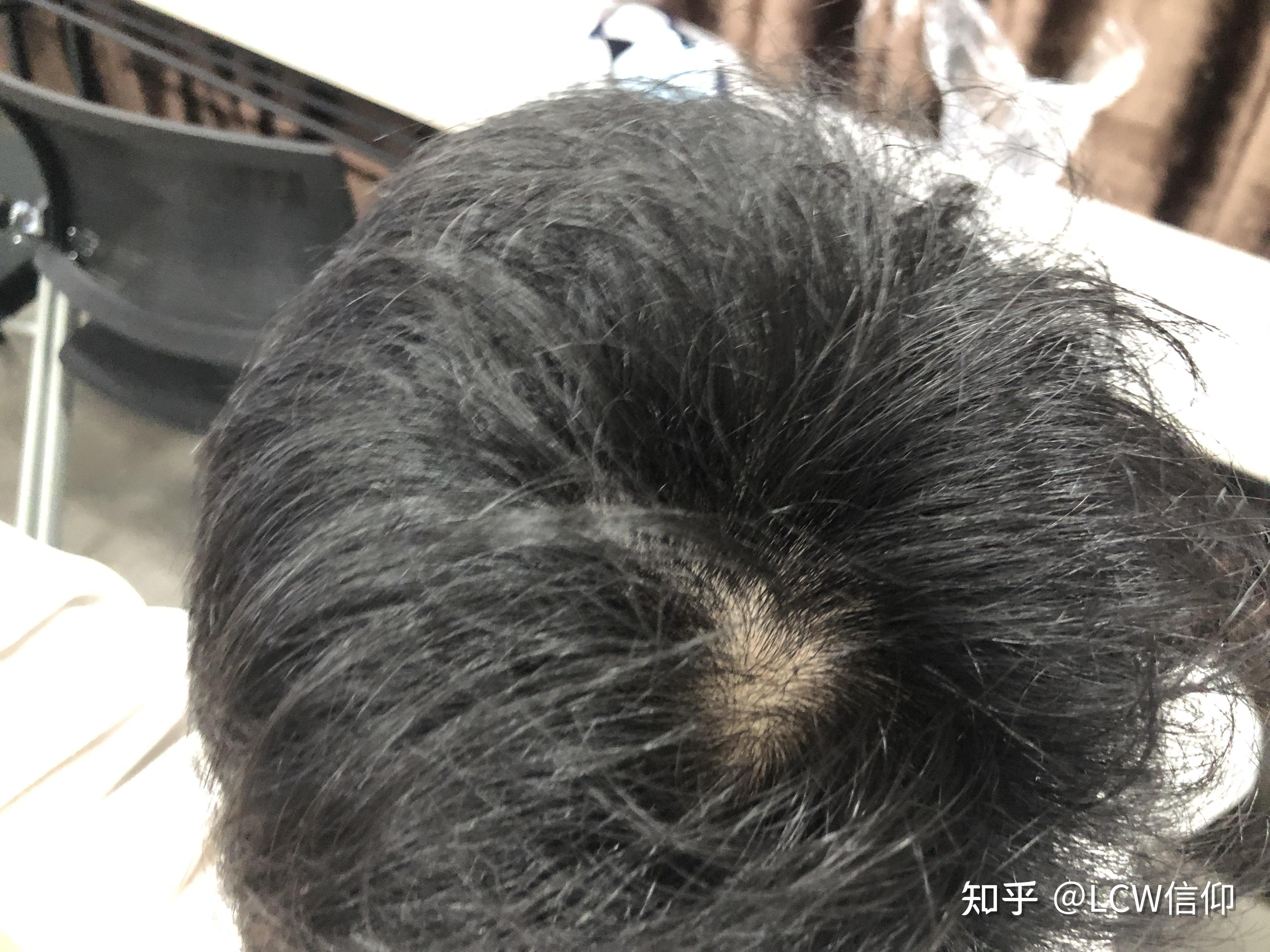 我这头顶漩涡处头发量正常吗? - 知乎