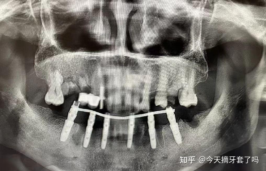 太老的老人還能種植牙嗎