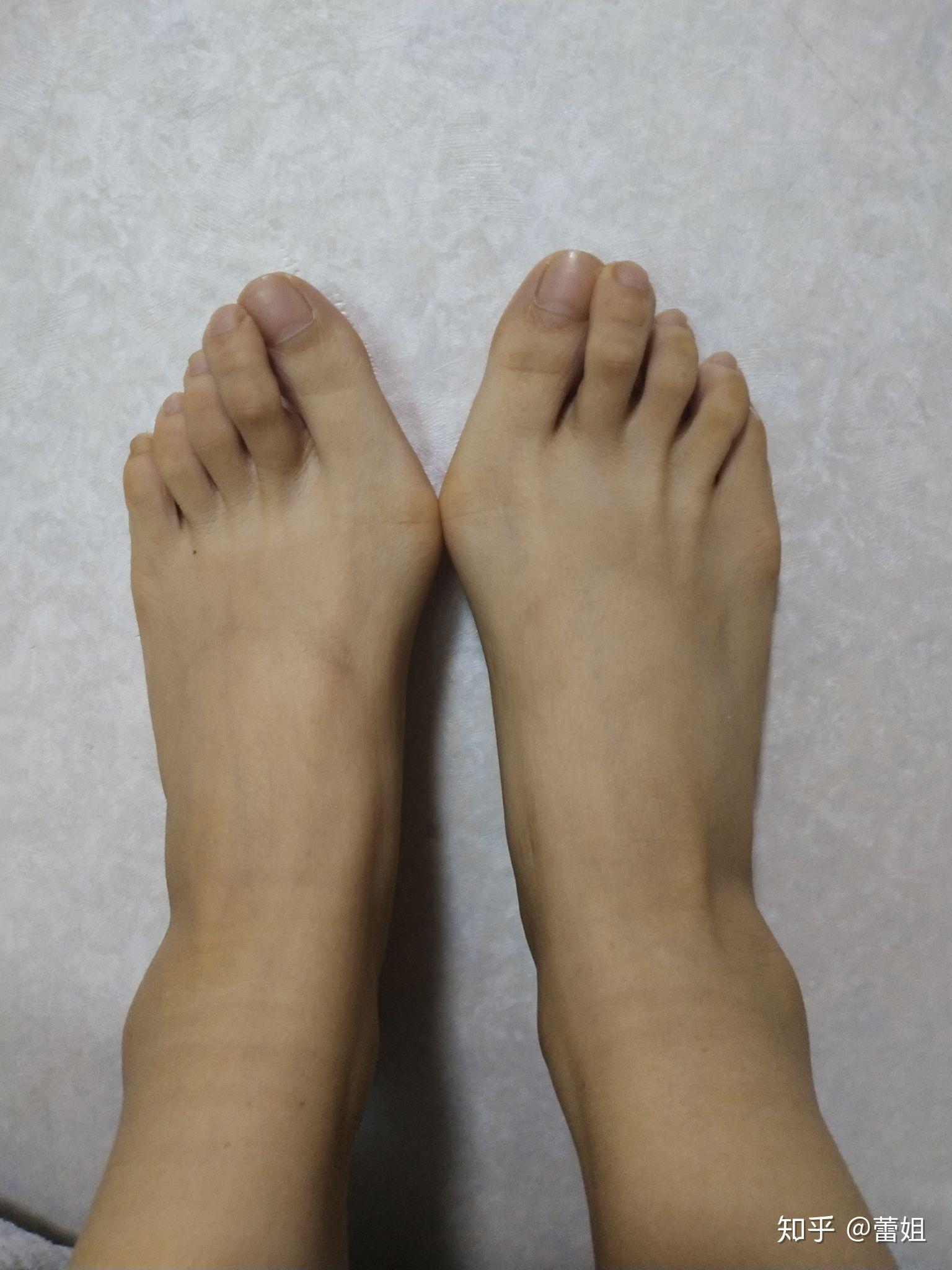 女生脚趾拇外翻是什么样体验
