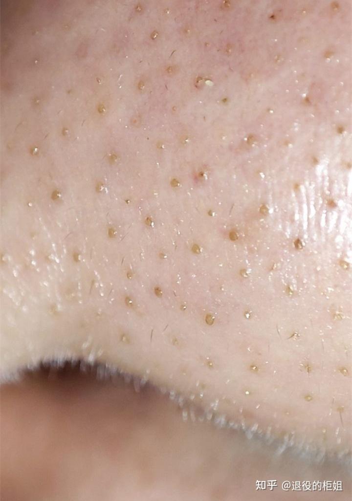 "油脂栓/脂质微丝"到底怎么去除?