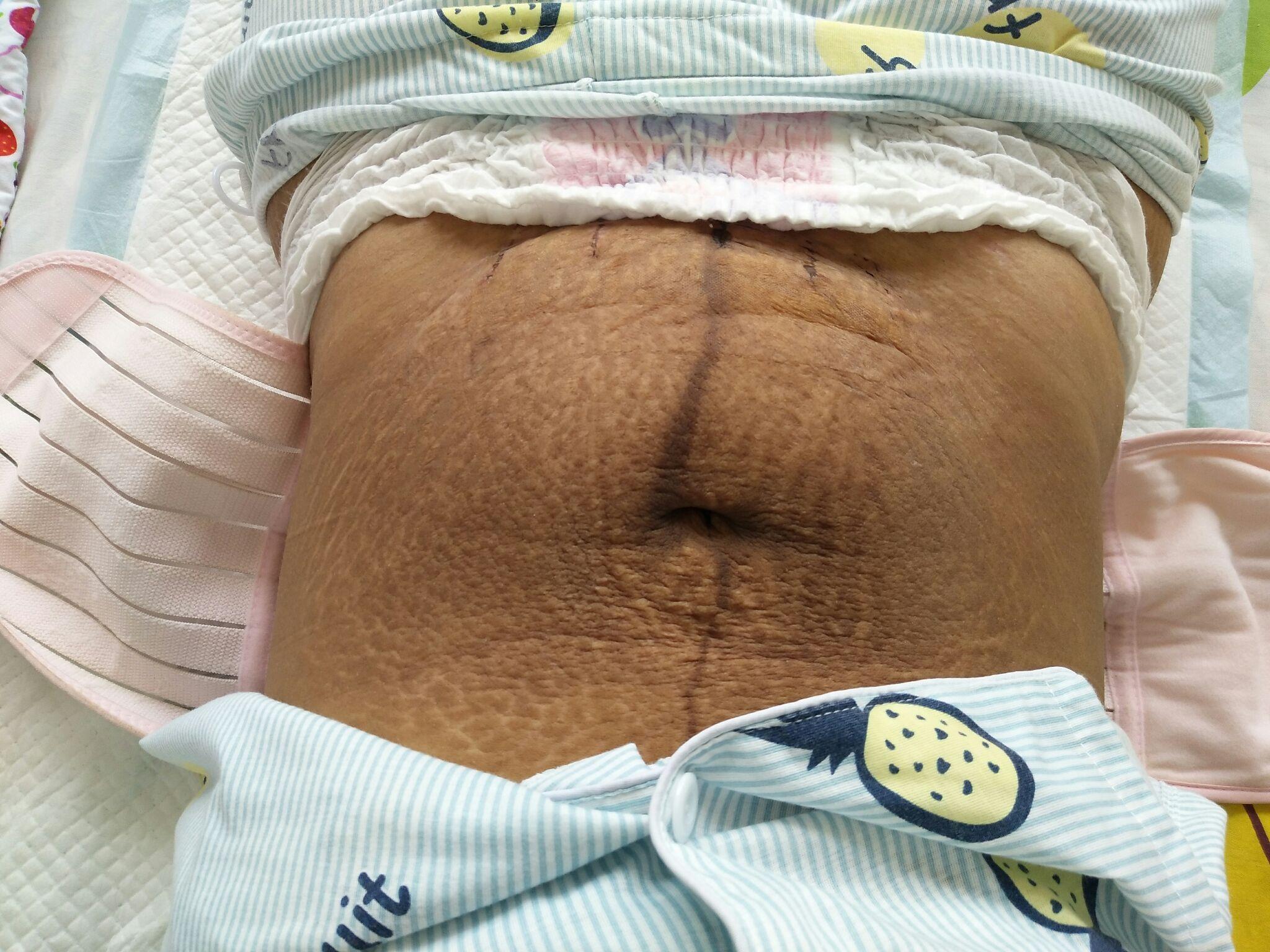 剖腹产后肚皮下垂图片图片
