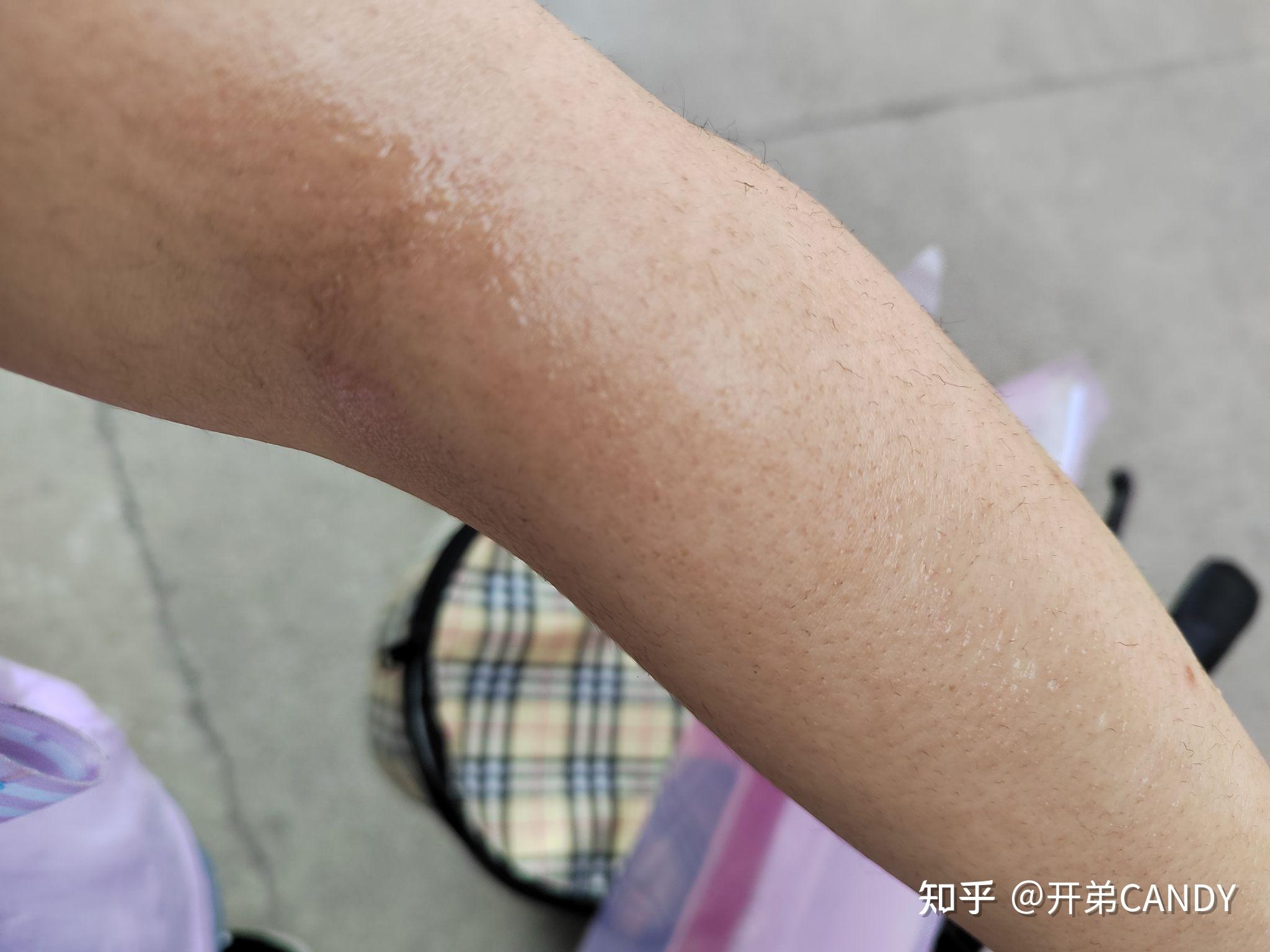 想问一下大家,用完脱毛膏有没有红肿过敏或者其他副作用? - 知乎