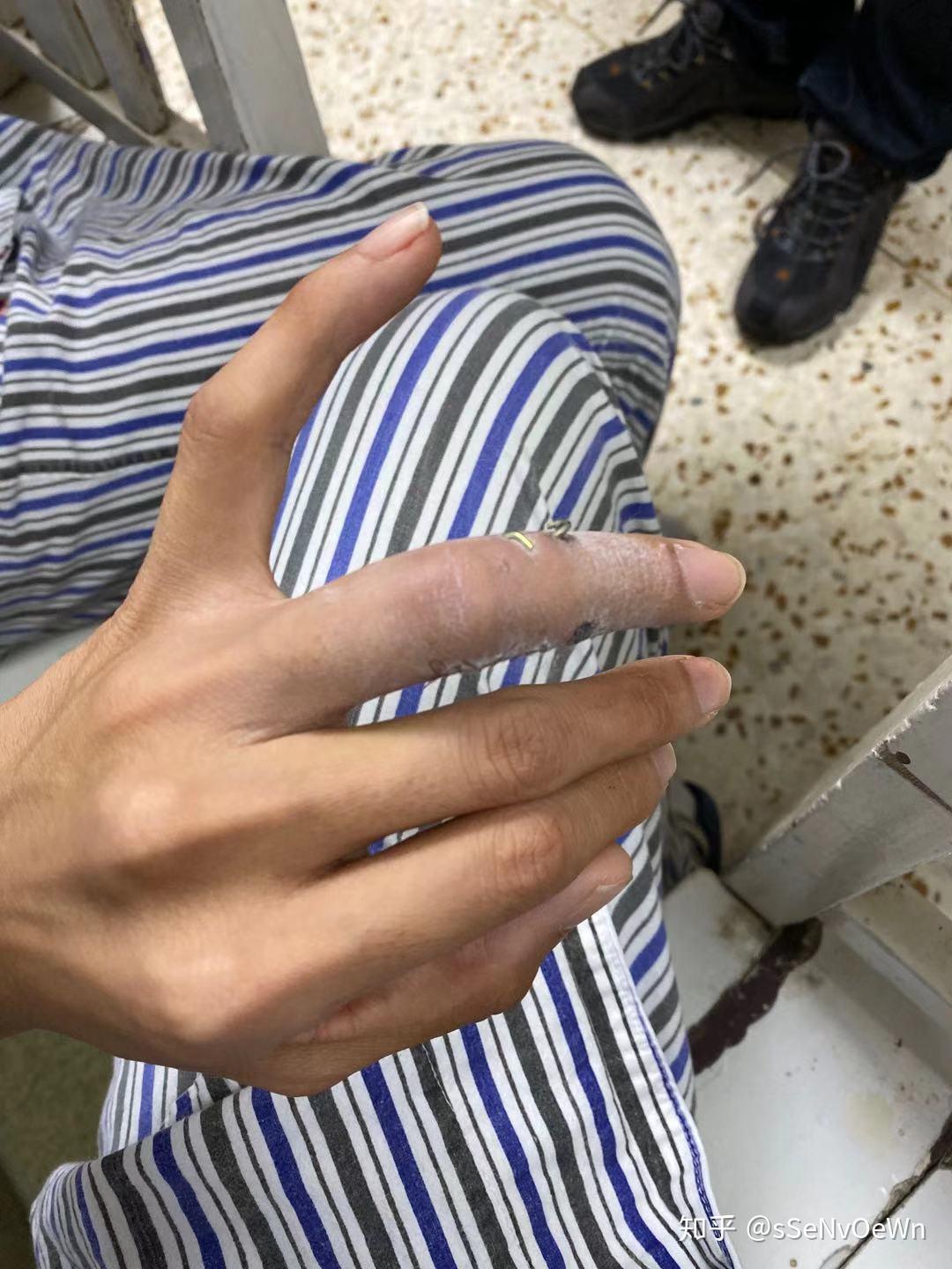 手指头骨折是种怎样的体验