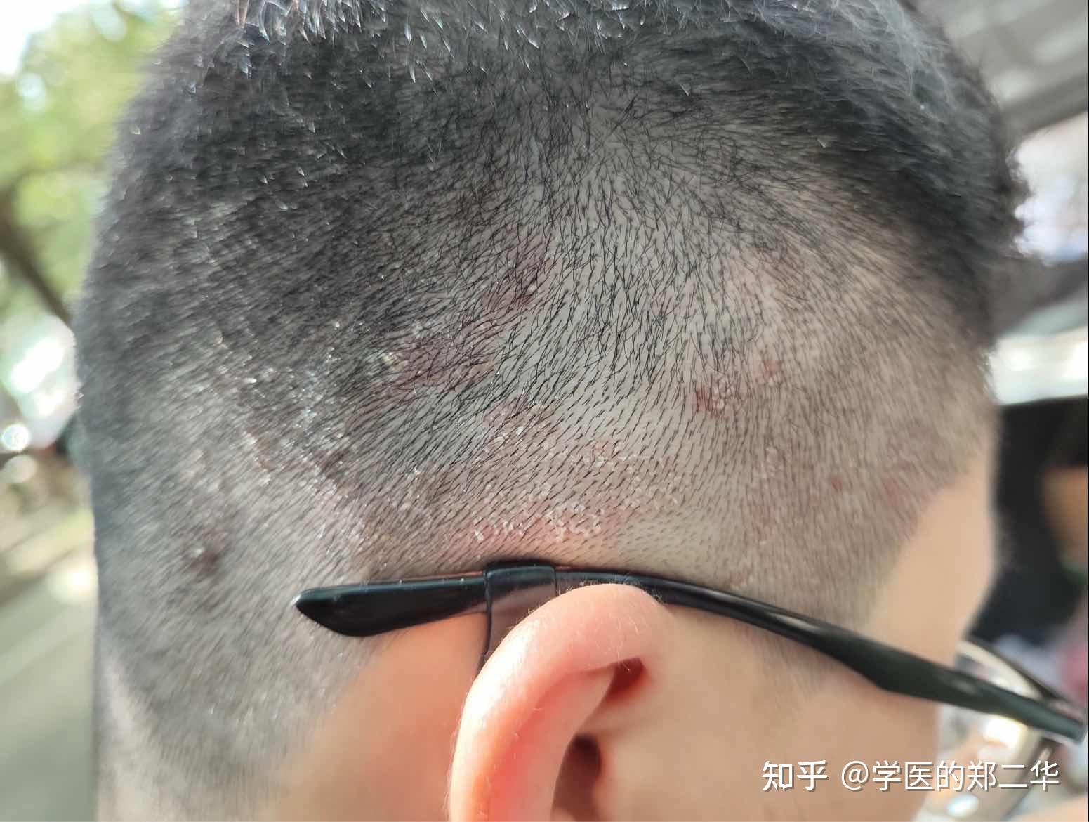 从医学角度来讲,头皮被感染真菌了,特别特别痒,有什么解决方法? - 知乎