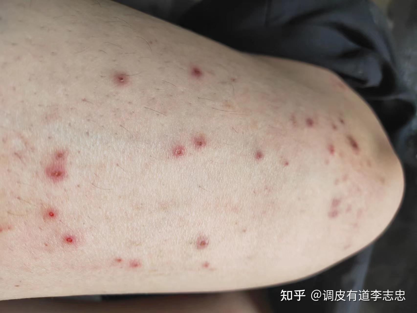 丘疹性荨麻疹多久可以治愈? - 知乎