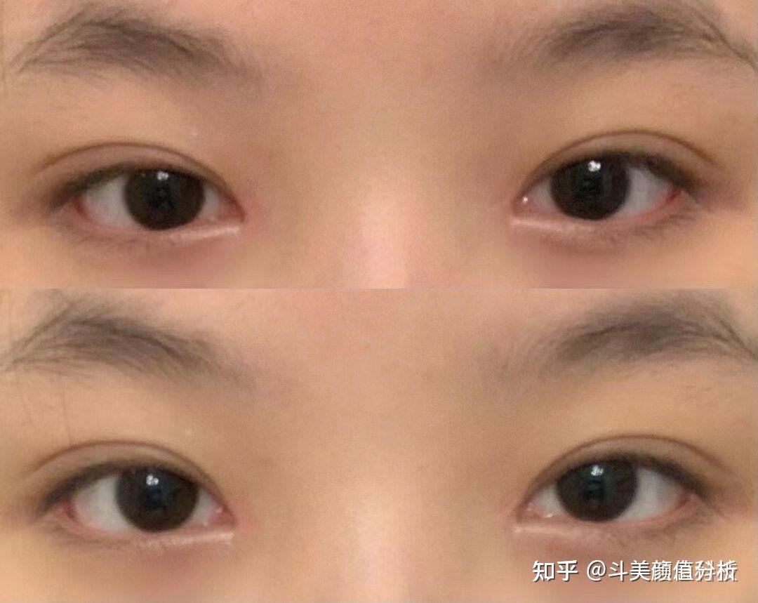 最常见的款式就是开扇形双眼皮这种双眼皮一定要保留轻微的内眦才显得