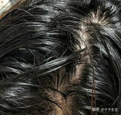 发缝宽掉发能用达霏欣吗？这些都是你想知道的！ - 知乎