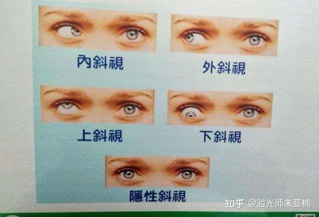 今天我们就来谈一谈和“斜视”有关的一些小知识 - 知乎