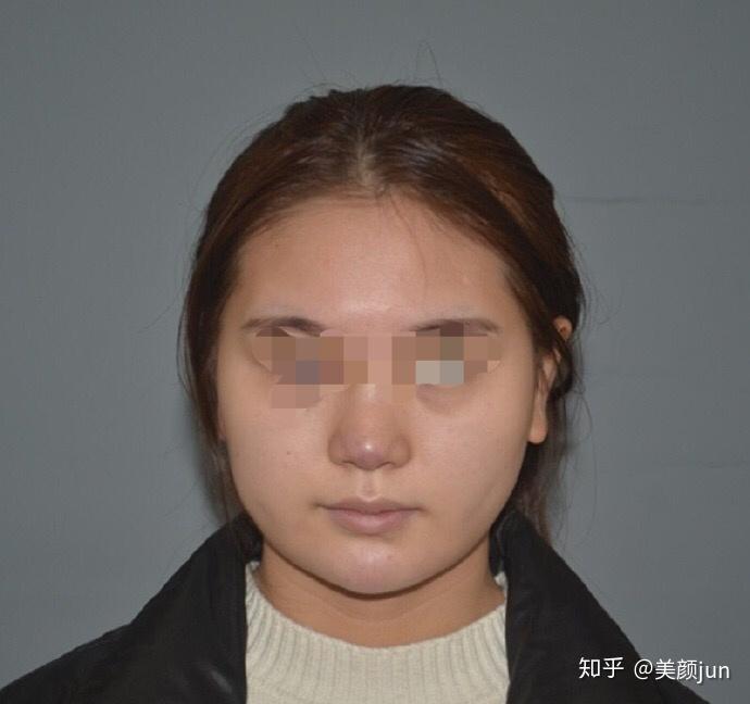 脸大而且颧骨宽下巴短是种什么体验哭唧唧