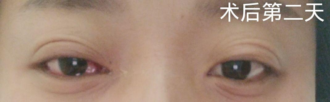 斜视手术后还有会复发的可能吗