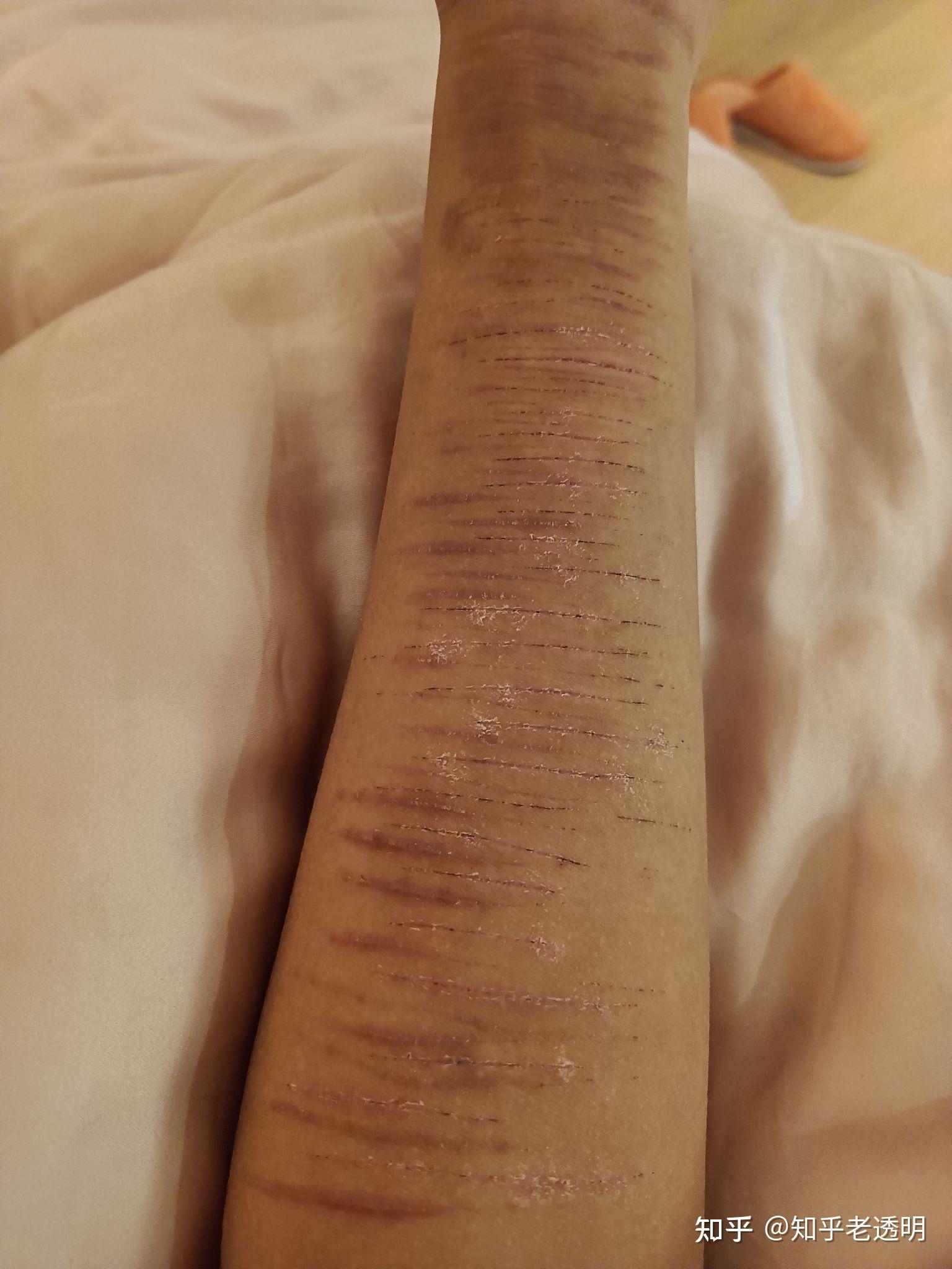 自残留下的疤真的很可笑吗? - 知乎