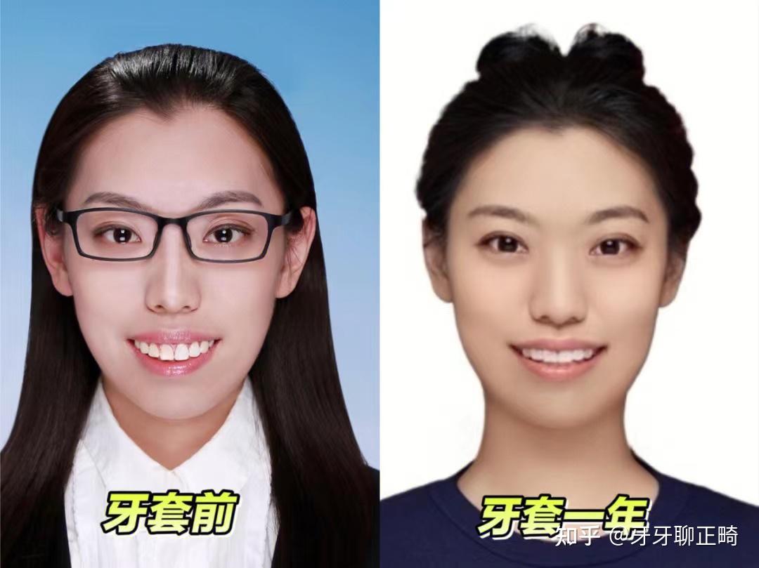 2024年牙齿矫正（正畸）超强攻略【整牙必看】 - 知乎
