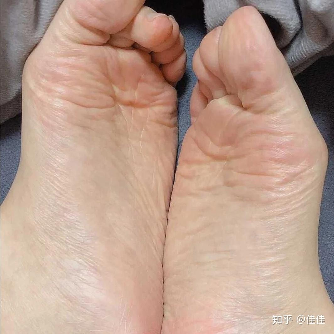 我的脚是汗脚所以经常出汗很臭怎么防止脚臭