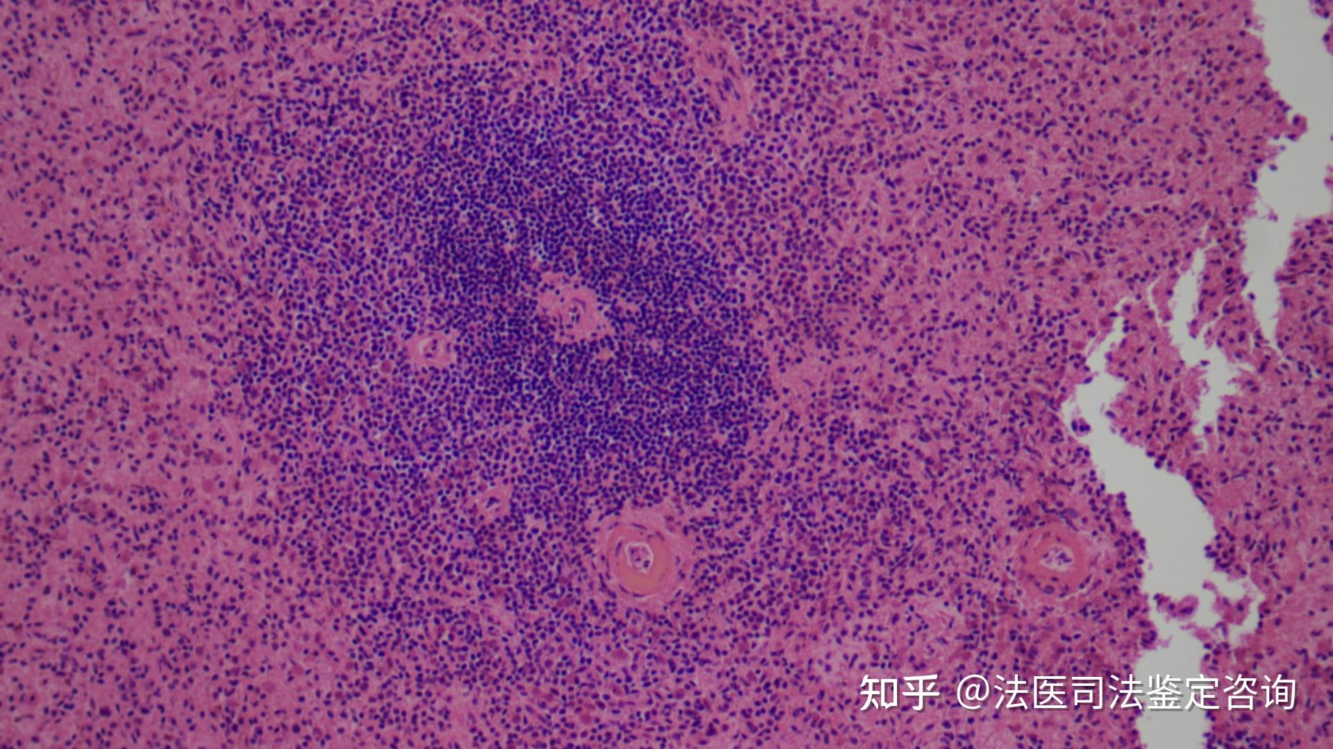 重症感染时脾脏的病理改变 - 知乎