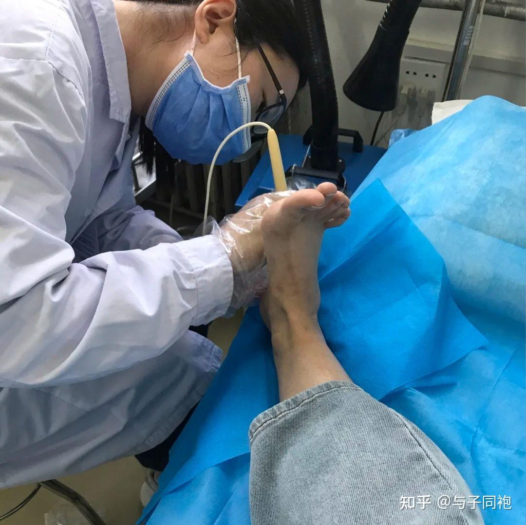 你是如何治好脚上长的鸡眼的? - 知乎