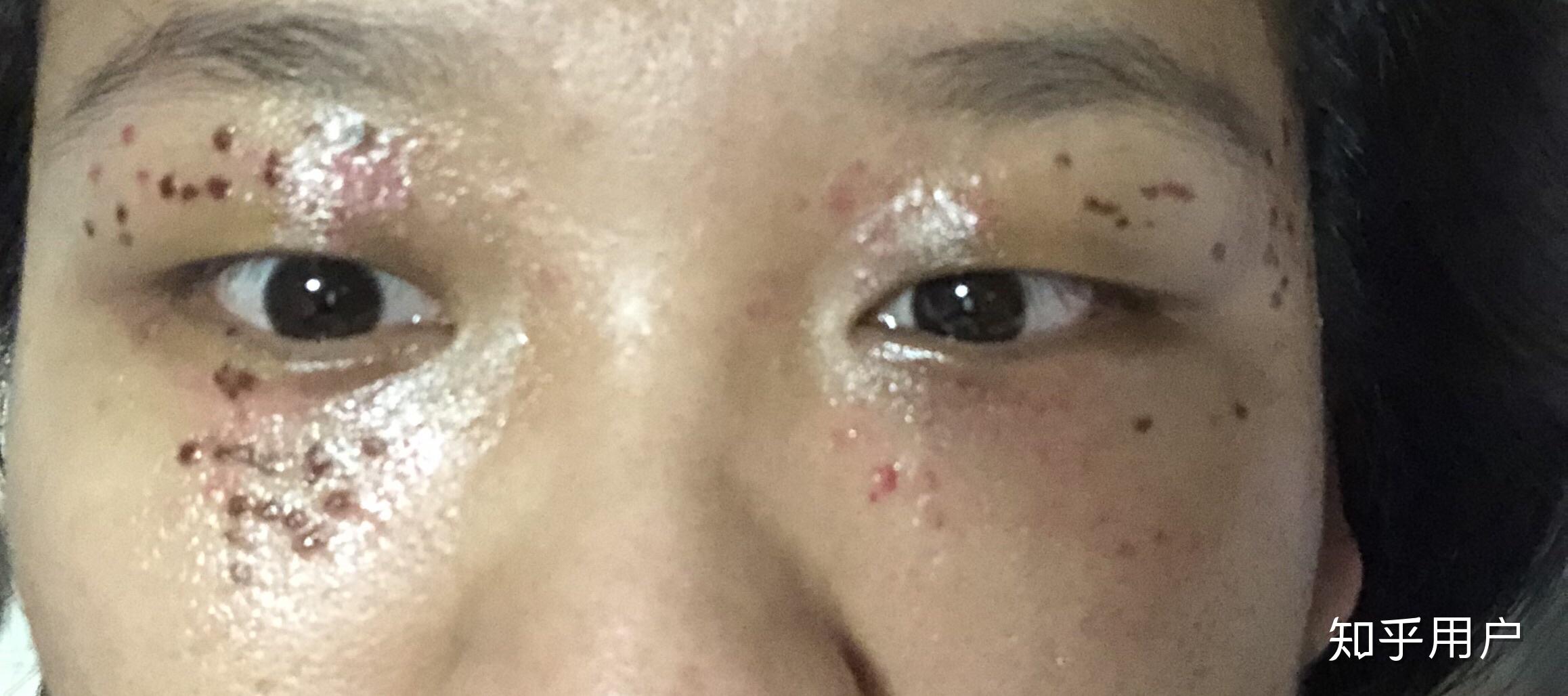 眼睛周围长了很多汗管瘤怎么办