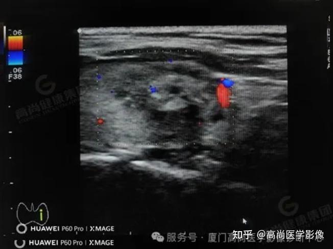 中年女老师经常生气时呼吸不畅,超声诊断甲状腺癌