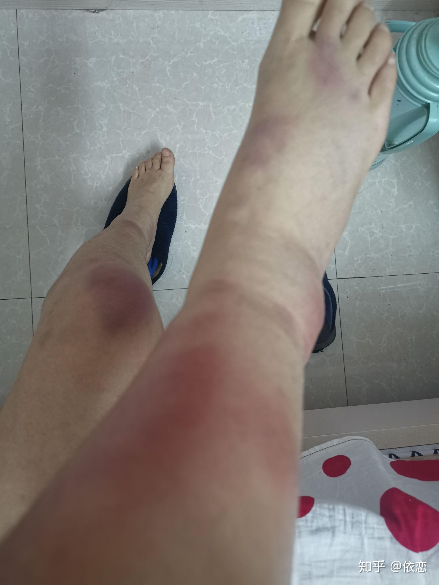 得过结节性红斑的人过来交流下? - 知乎